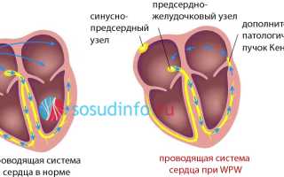 Отличие феномена wpw от синдрома