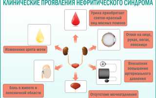 Отличия нефротического синдрома от нефритического