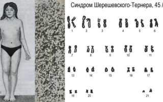 Синдром шерешевского тернера краткое сообщение