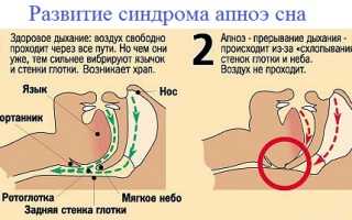 Синдром ночного апноэ по мкб 10