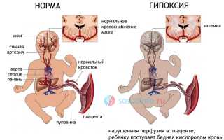 Гипоксически ишемическое поражение цнс синдром тонусных нарушений