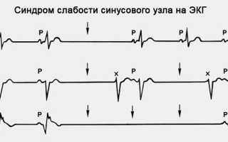 Экг синдром слабости синусового узла