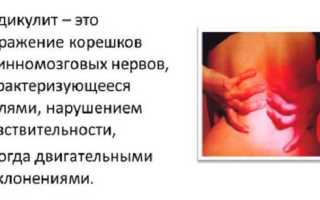 Пояснично крестцовый радикулит с корешковым синдромом