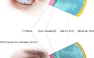 Синдром сухого глаза у кого такое было