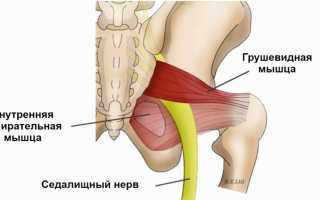 Лечение синдрома грушевидной в домашних