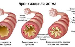 Предастма код по мкб 10