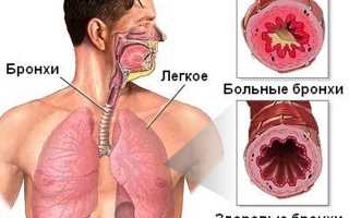 Острый бронхит с астматическим синдромом