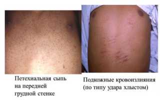 Геморрагический синдром в виде гематом имеет место при