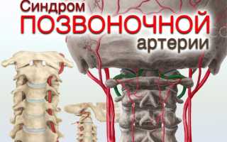 Лечебная гимнастика синдром позвоночной артерии