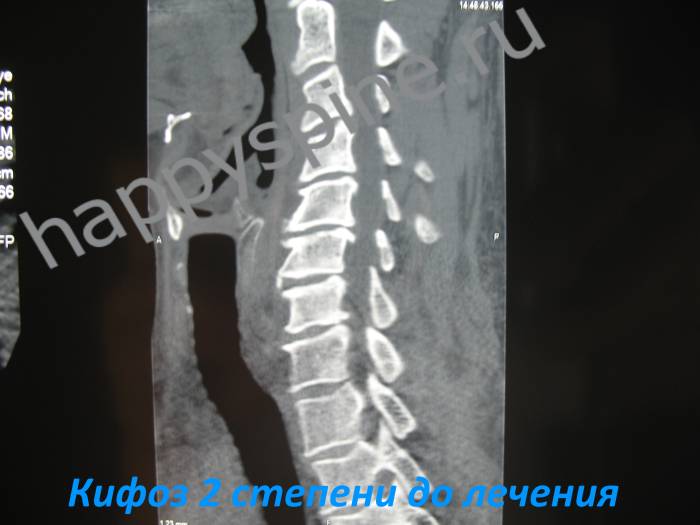 шейный отдел позвоночника