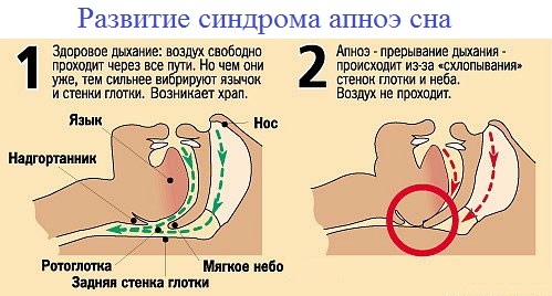Апноэ во сне