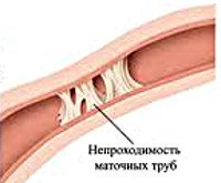 N97.1 Женское бесплодие трубного происхождения