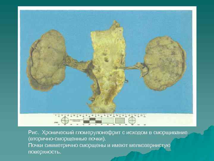 >Рис. Хронический гломерулонефрит с исходом в сморщивание (вторично сморщенные почки). Почки симметрично сморщены и