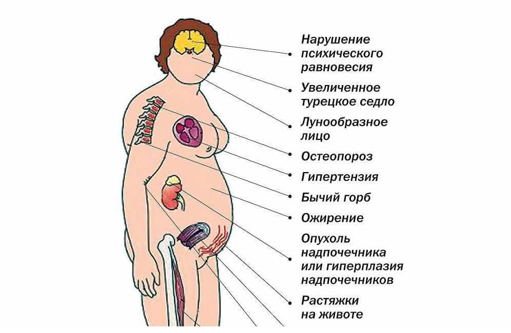 Лечение синдрома кушинга у женщин препараты