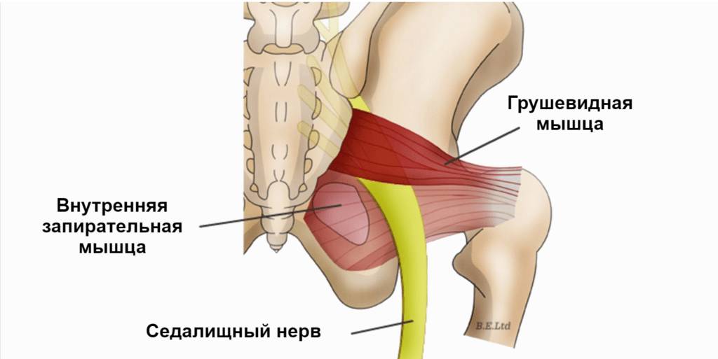 Лечение синдрома грушевидной в домашних