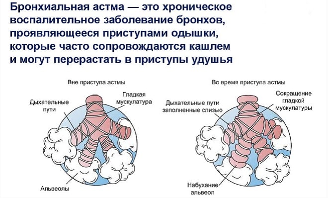 обозначение бронхиальной астмы