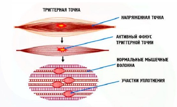 Миофасциальный синдром
