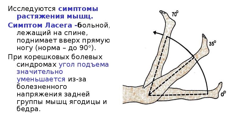Положительный симптом Фальре (Ласега-Фальре)