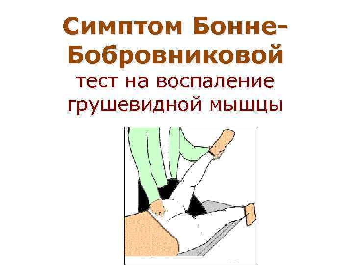 Положительный симптом грушевидной мышцы (симптом Бонне-Бобровниковой)