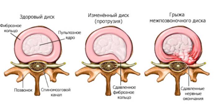 Протрузия и грыжа