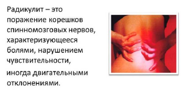 Радикулит