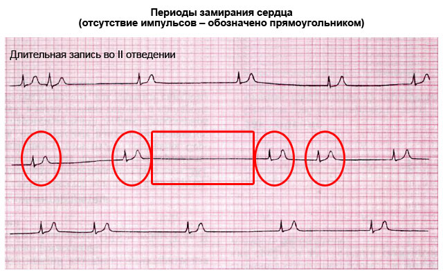 Синдром слабости синусового узла лечение народными средствами