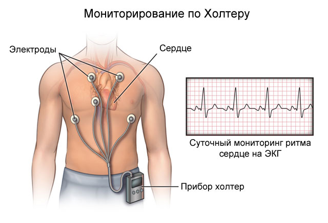 Синдром слабости синусового узла лечение народными средствами