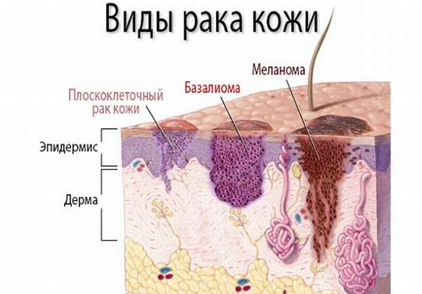 Базалиома носа код мкб