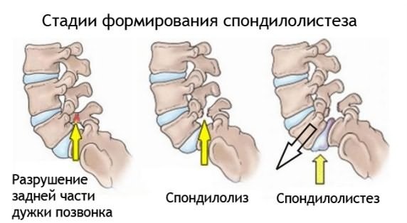 Спондилолистез