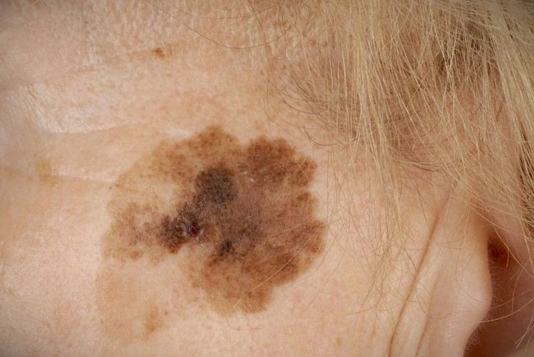 melanoma