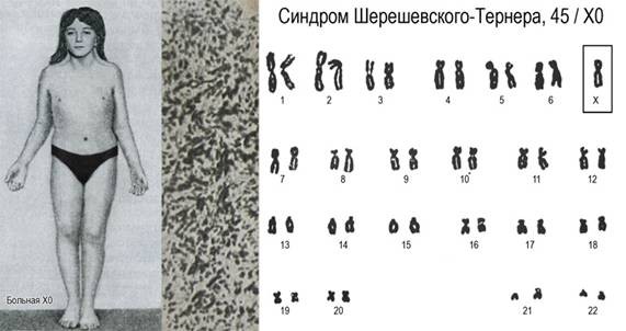 Синдром Шерешевского-Тернера