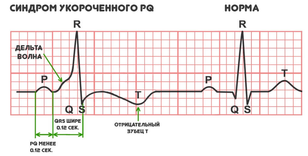 Синдром укороченного интервала pq код мкб