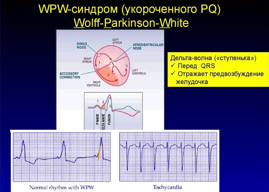 Синдром укороченного интервала pq код мкб