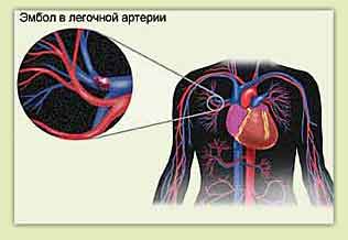 Тромбоэмболия легочной артерии