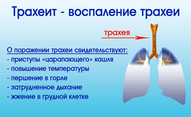 Воспаление трахеи – серьезное осложнение болезни