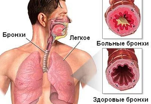 Здоровые бронхи и воспаленные при поражении астматическим бронхитом